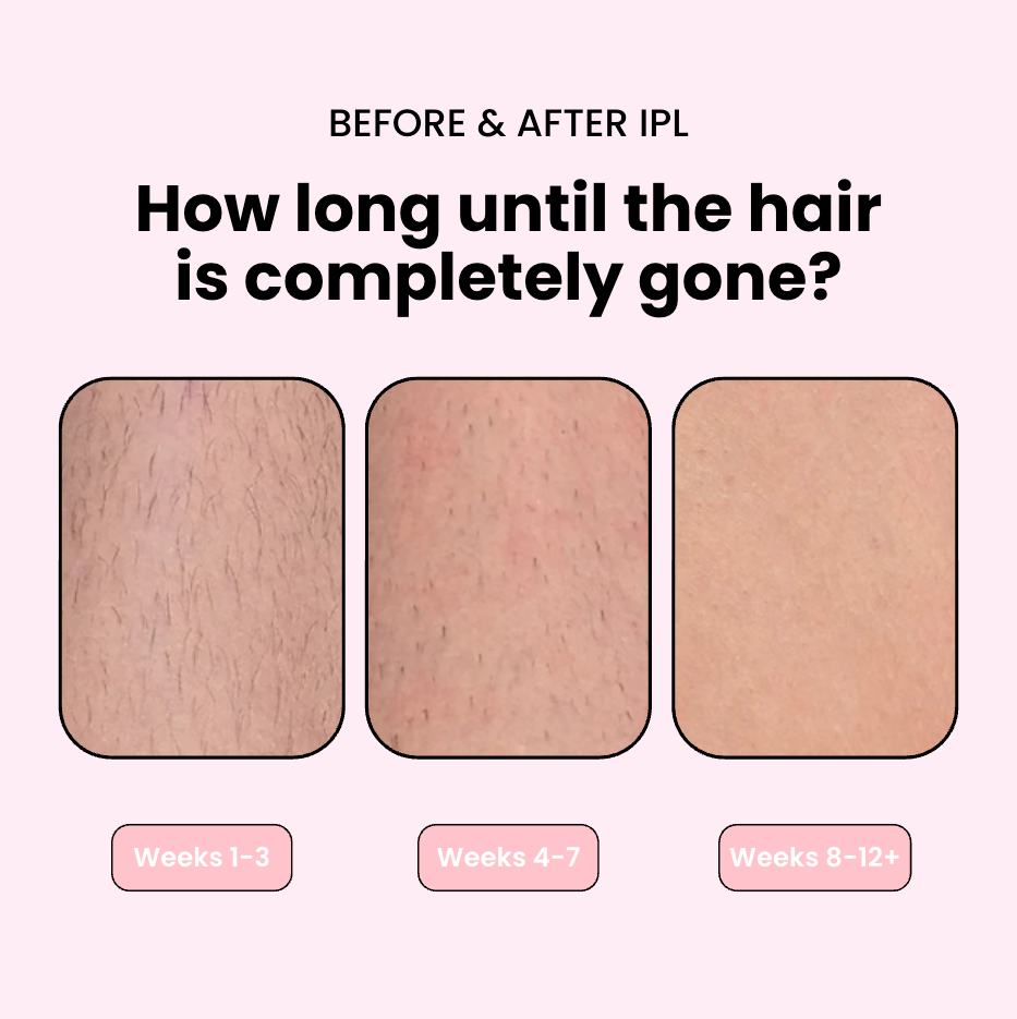 Flair Pro 2.0 IPL Hair Remover