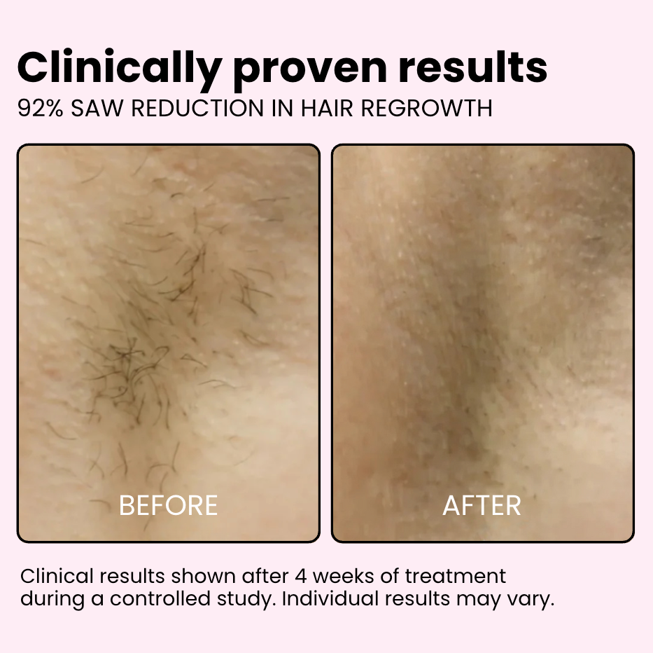Flair Pro 2.0 IPL Hair Remover
